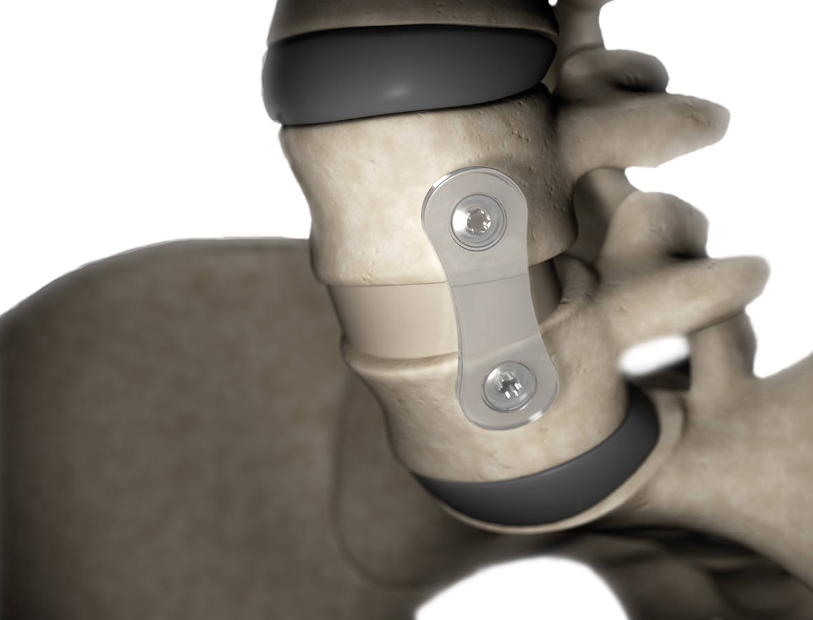 Placa Cervical Reabsorbible