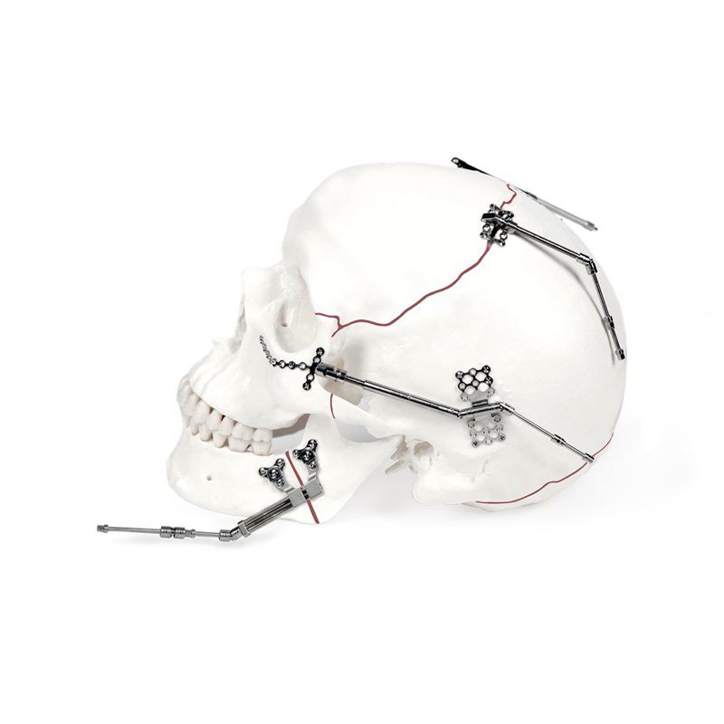 Distracción Osteogénica