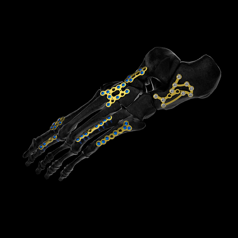 Osteosíntesis Calcáneo