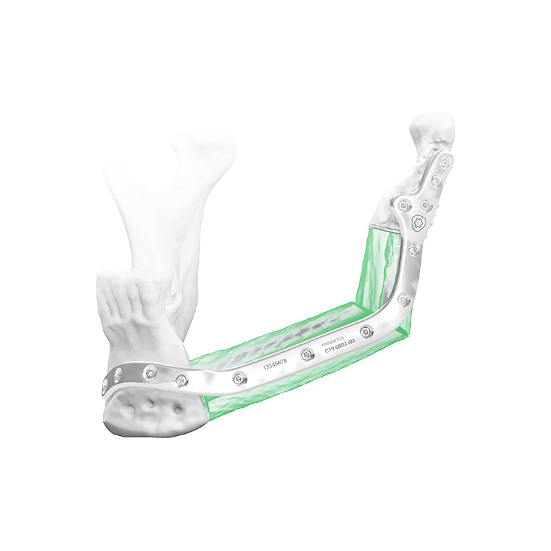 Reconstrucción Mandibular