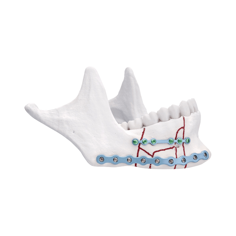 Trauma Mandibular