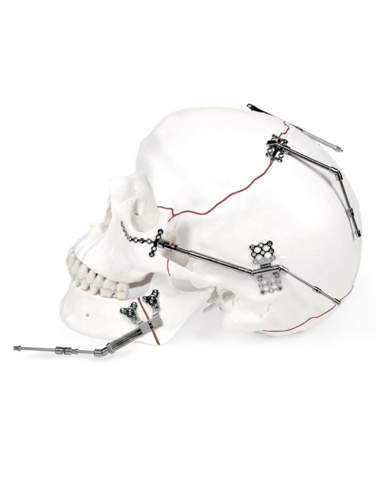 Distracción Osteogénica