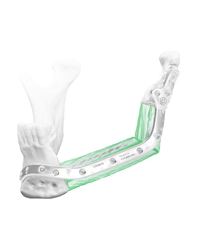 Reconstrucción Mandibular