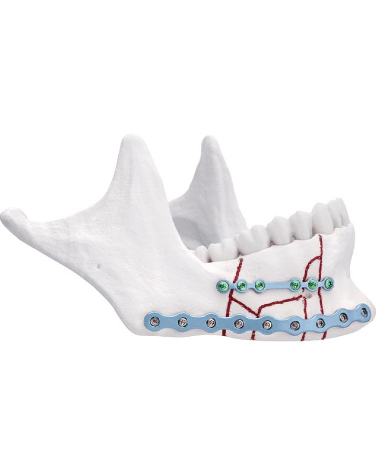 Trauma Mandibular